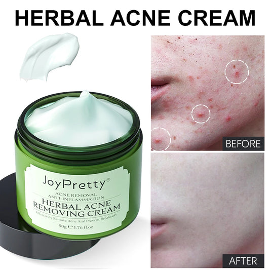 Herbal Acne Face Cream Pimple Marks Removal Oil Control Moisturizing Pockmark Smooth Facial Creams Skin Care Products Joypretty