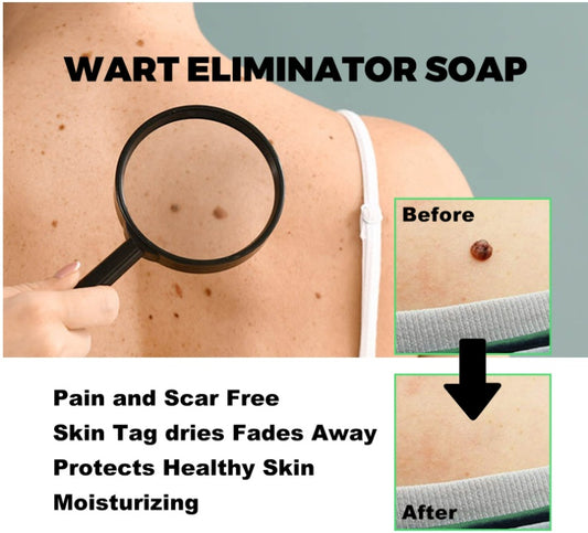 Mole Removal G Wart Grain Filamentous Wart Body Cleaning Soap