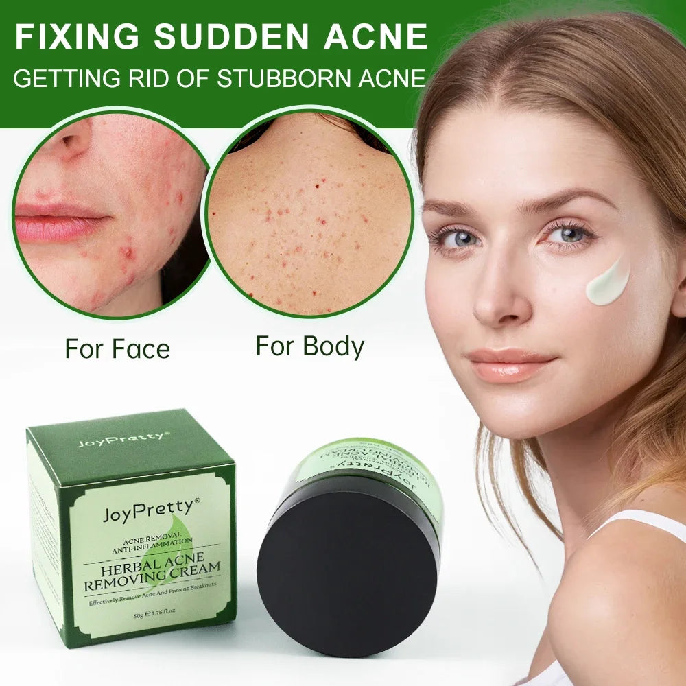 Herbal Acne Face Cream Pimple Marks Removal Oil Control Moisturizing Pockmark Smooth Facial Creams Skin Care Products Joypretty